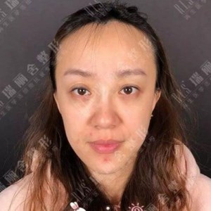 瑞麗舍整形馬君做的全臉自體脂肪填充，不錯(cuò)呢~