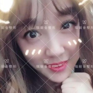 瑞麗舍整形馬君做的全臉自體脂肪填充，不錯(cuò)呢~