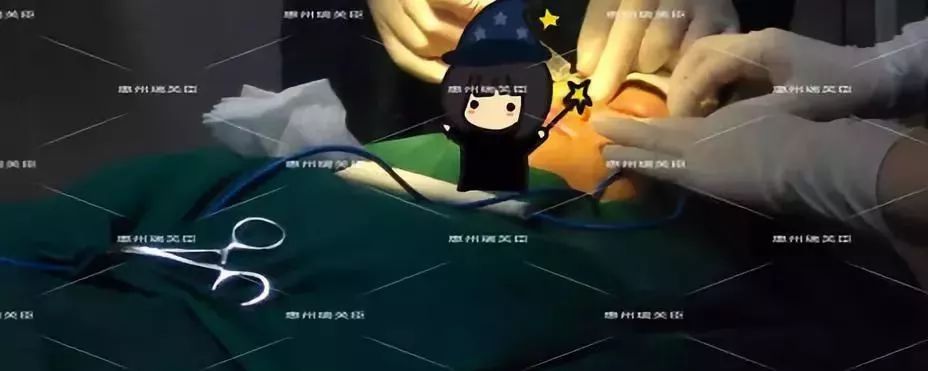 惠州瑞芙臣劉丹虹雙眼皮+開眼角整形日記~