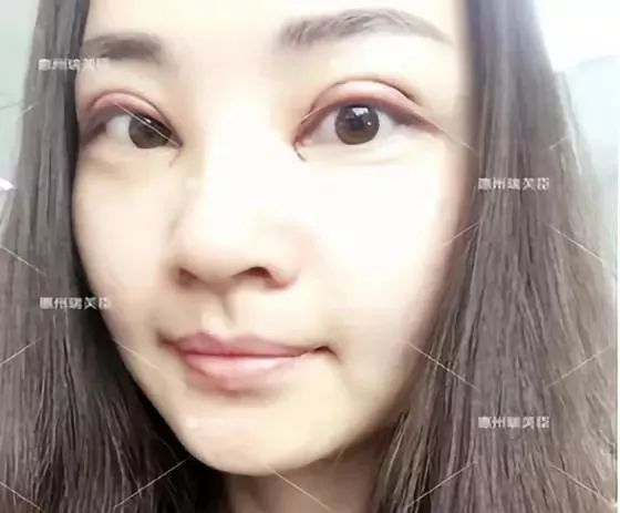 惠州瑞芙臣劉丹虹雙眼皮+開眼角整形日記~