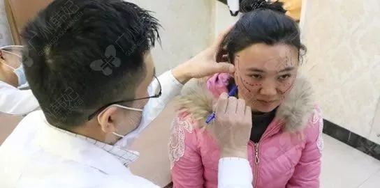 廣州韓妃美版超聲提拉和埋線提升提升日記一則，給你好看~