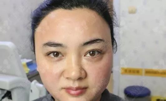 廣州韓妃美版超聲提拉和埋線提升提升日記一則，給你好看~