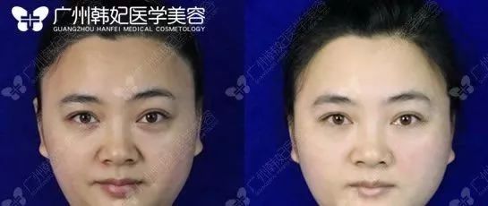 廣州韓妃美版超聲提拉和埋線提升提升日記一則，給你好看~