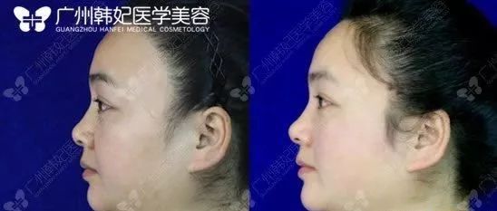 廣州韓妃美版超聲提拉和埋線提升提升日記一則，給你好看~