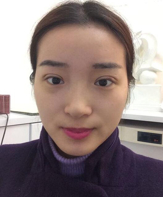 深圳陽(yáng)光醫(yī)院雙眼皮一個(gè)月恢復(fù)圖 日記見(jiàn)證蛻變