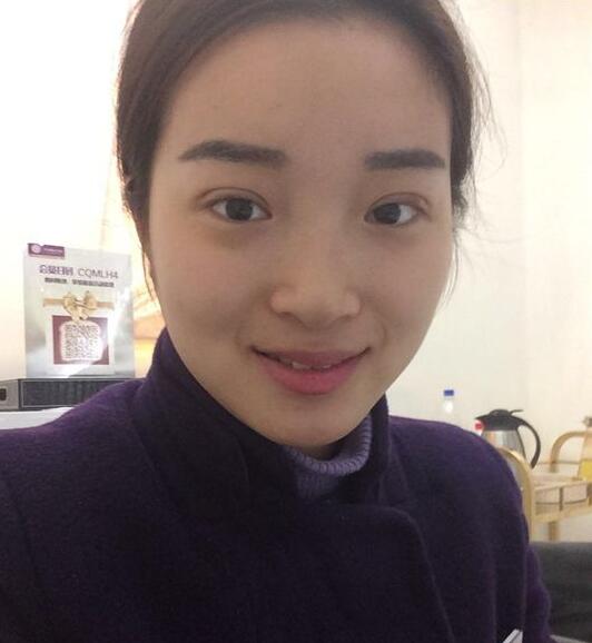 深圳陽(yáng)光醫(yī)院雙眼皮一個(gè)月恢復(fù)圖 日記見(jiàn)證蛻變