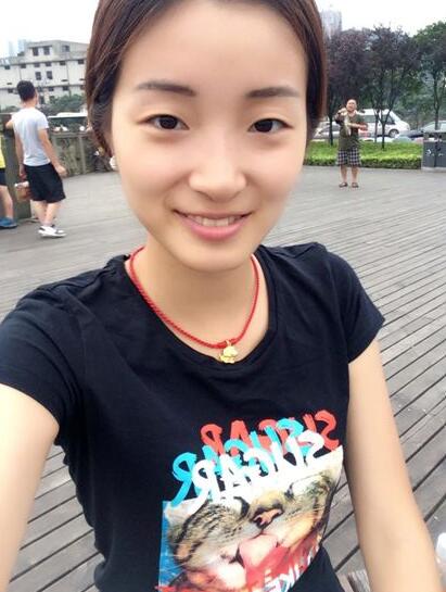 深圳陽(yáng)光醫(yī)院雙眼皮一個(gè)月恢復(fù)圖 日記見(jiàn)證蛻變