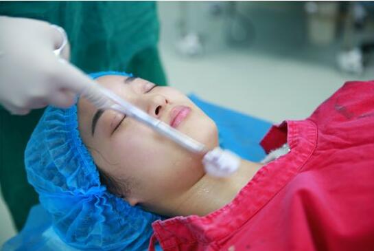 深圳陽(yáng)光醫(yī)院雙眼皮一個(gè)月恢復(fù)圖 日記見(jiàn)證蛻變