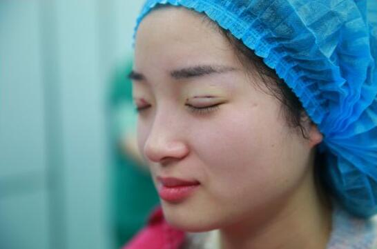 深圳陽(yáng)光醫(yī)院雙眼皮一個(gè)月恢復(fù)圖 日記見(jiàn)證蛻變