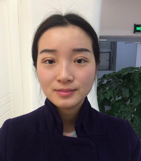 深圳陽(yáng)光醫(yī)院雙眼皮一個(gè)月恢復(fù)圖 日記見(jiàn)證蛻變