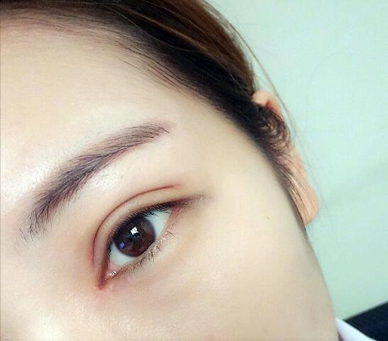 重慶五洲整形醫(yī)院醫(yī)生技術(shù)口碑|雙眼皮案例實(shí)記分享