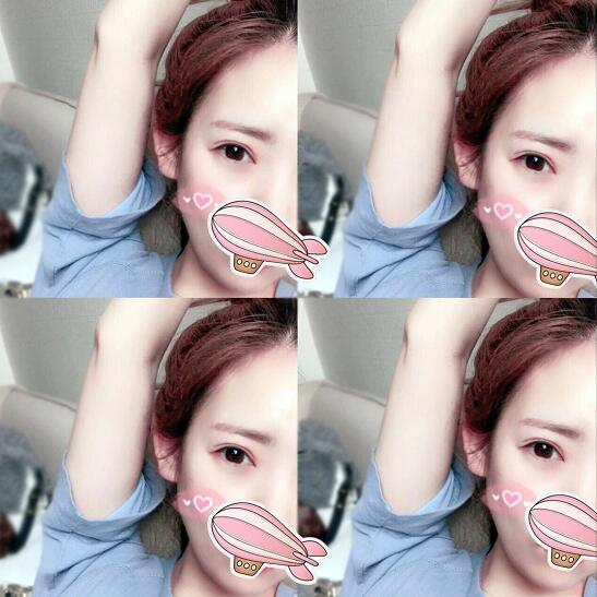 重慶五洲整形醫(yī)院醫(yī)生技術(shù)口碑|雙眼皮案例實(shí)記分享