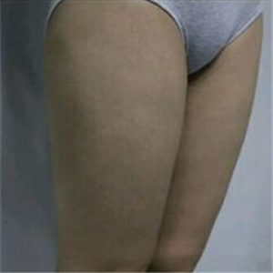 去找東方和諧馮斌做了大腿抽脂，分享一下果吧！