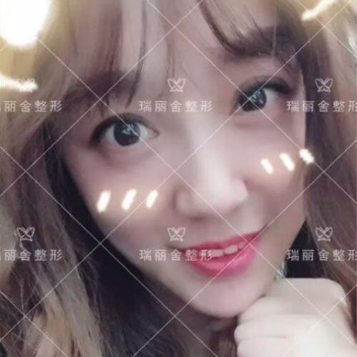 臉頰脂肪填充術(shù)后30天果