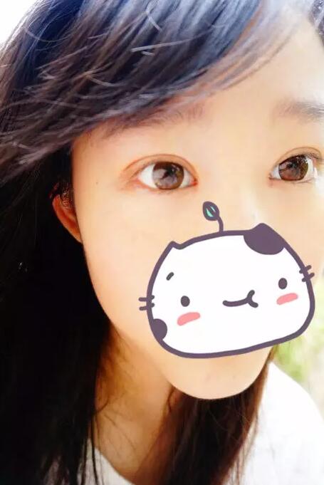 張毅整形醫(yī)生雙眼皮圖分享日記手札