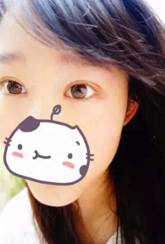 張毅整形醫(yī)生雙眼皮圖分享日記手札