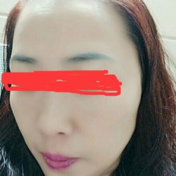 北京邦定張亞昆做的面部提升，果較為不錯(cuò)~