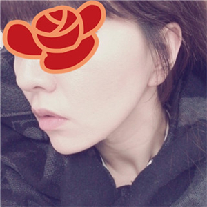 北京南加安棟顯給我做的自體脂肪去法令紋，果很好~