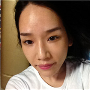 北京南加高紅霞醫(yī)生做的頭發(fā)種植，恢復(fù)得很好~