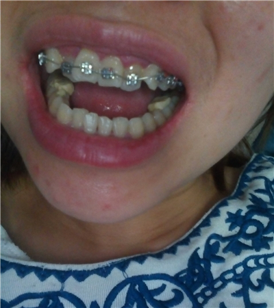 成都圣貝口腔翟永森做的牙齒矯正，分享果照片~