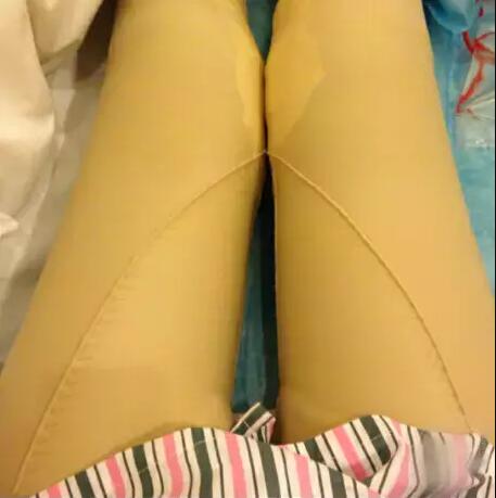 哈醫(yī)大二院整形科徐學(xué)武大腿吸脂術(shù)前后恢復(fù)分享手記