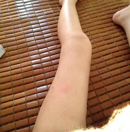 哈醫(yī)大二院整形科徐學(xué)武大腿吸脂術(shù)前后恢復(fù)分享手記