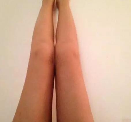 哈醫(yī)大二院整形科徐學(xué)武大腿吸脂術(shù)前后恢復(fù)分享手記