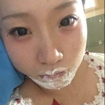 北京麗詩(shī)麗格楊明強(qiáng)玻尿酸豐唇半個(gè)月了，看看果~