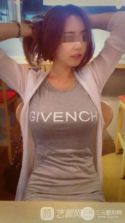 北京隆胸抽脂多少錢?北京東方和諧自體脂肪豐胸案例