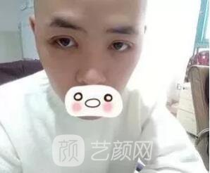 愛思特張姣姣雙眼皮案例照片日記 男生也會做雙眼皮手術哦