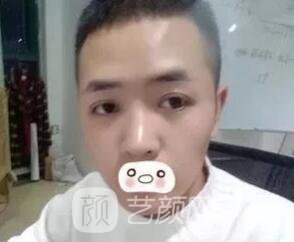 愛思特張姣姣雙眼皮案例照片日記 男生也會做雙眼皮手術哦