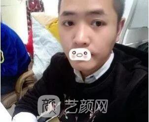 愛思特張姣姣雙眼皮案例照片日記 男生也會做雙眼皮手術哦