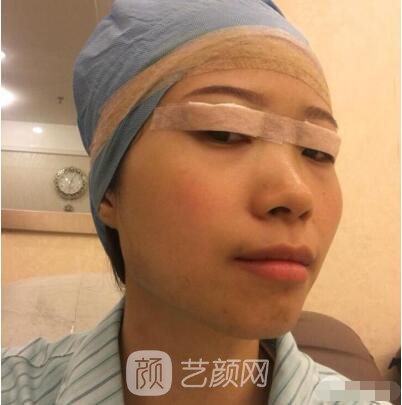 莊璐全切雙眼皮照 全過(guò)程恢復(fù)經(jīng)驗(yàn)之談