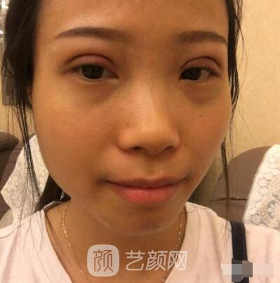 莊璐全切雙眼皮照 全過(guò)程恢復(fù)經(jīng)驗(yàn)之談