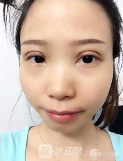 莊璐全切雙眼皮照 全過(guò)程恢復(fù)經(jīng)驗(yàn)之談