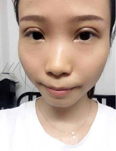 莊璐全切雙眼皮照 全過(guò)程恢復(fù)經(jīng)驗(yàn)之談