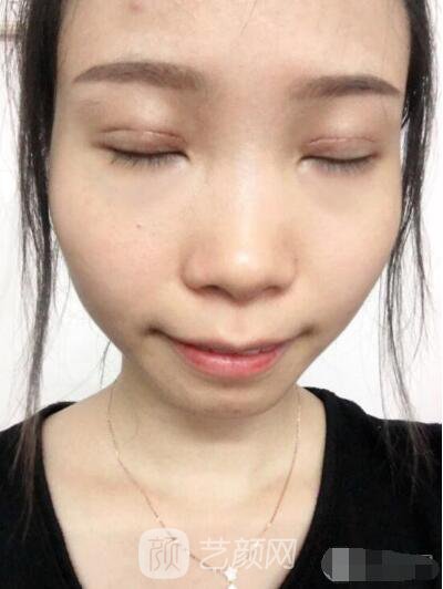 莊璐全切雙眼皮照 全過(guò)程恢復(fù)經(jīng)驗(yàn)之談