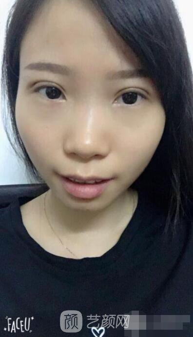 莊璐全切雙眼皮照 全過(guò)程恢復(fù)經(jīng)驗(yàn)之談