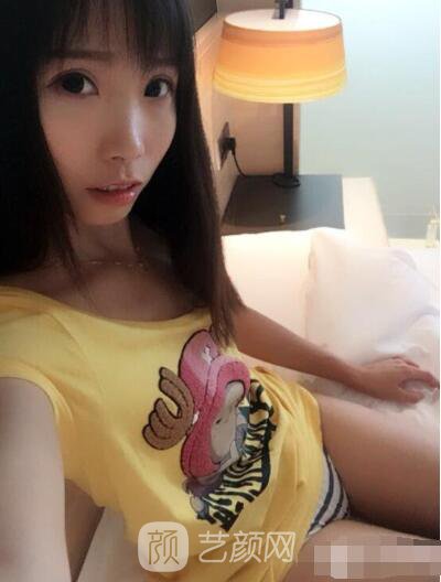 莊璐全切雙眼皮照 全過(guò)程恢復(fù)經(jīng)驗(yàn)之談