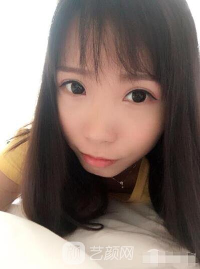 莊璐全切雙眼皮照 全過(guò)程恢復(fù)經(jīng)驗(yàn)之談