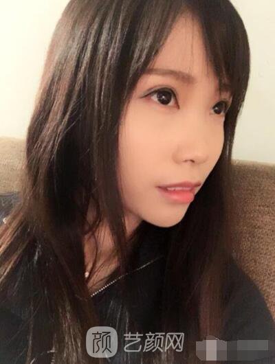 莊璐全切雙眼皮照 全過(guò)程恢復(fù)經(jīng)驗(yàn)之談