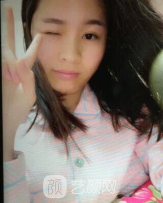 福州比華利林秋蓉激光祛痘圖 滿臉痘痘到光滑肌膚