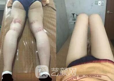 東莞締美陳星光大腿吸脂照片 內(nèi)附全部恢復(fù)過程體驗(yàn)