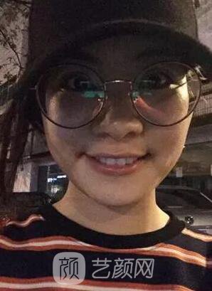 西安碑林西美王艷娜雙眼皮圖 真實案例心情分享