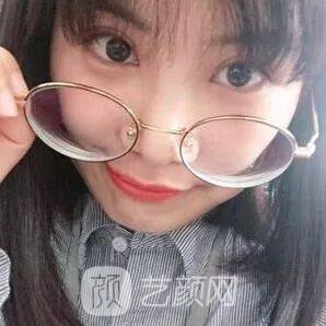 西安碑林西美王艷娜雙眼皮圖 真實案例心情分享