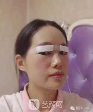 王紅敏切開雙眼皮+開內(nèi)眼角圖術(shù)后心情小述