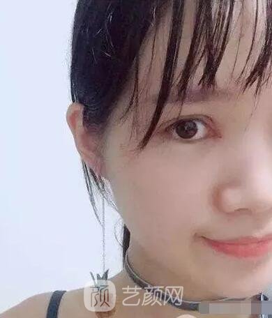 王紅敏切開雙眼皮+開內(nèi)眼角圖術(shù)后心情小述