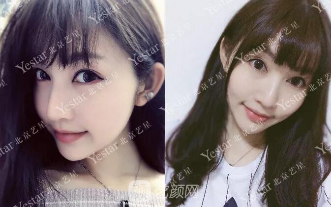 北京藝星整形醫(yī)院注射瘦臉￥499 | 打完半個(gè)月，來(lái)看看果!