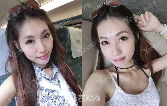 北京藝星整形醫(yī)院注射瘦臉￥499 | 打完半個(gè)月，來(lái)看看果!