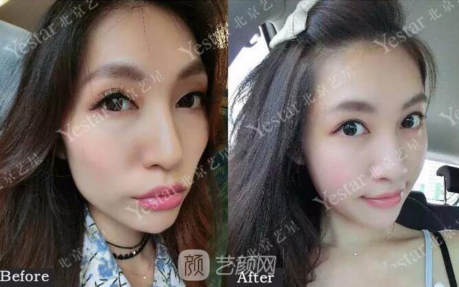 北京藝星整形醫(yī)院注射瘦臉￥499 | 打完半個(gè)月，來(lái)看看果!